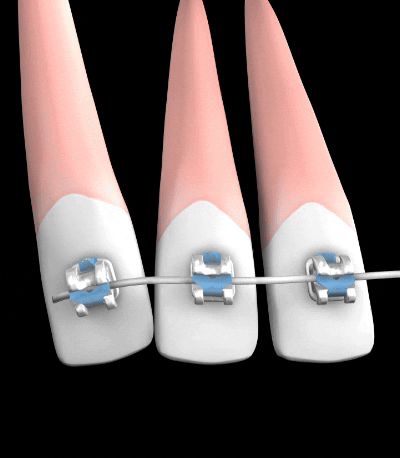 Self-Ligating Brackets